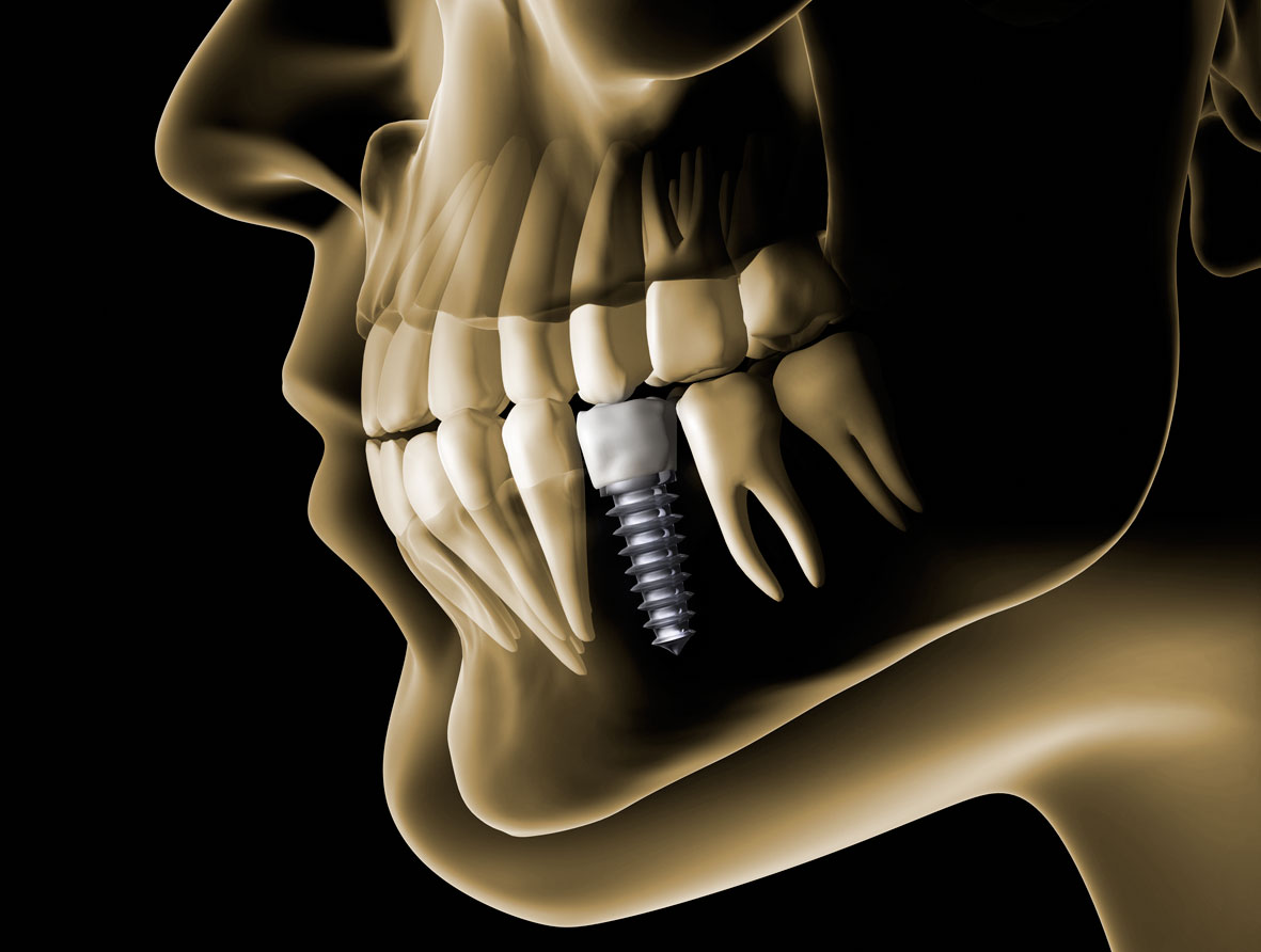 IMPLANTES-RAQUELCOLONPK