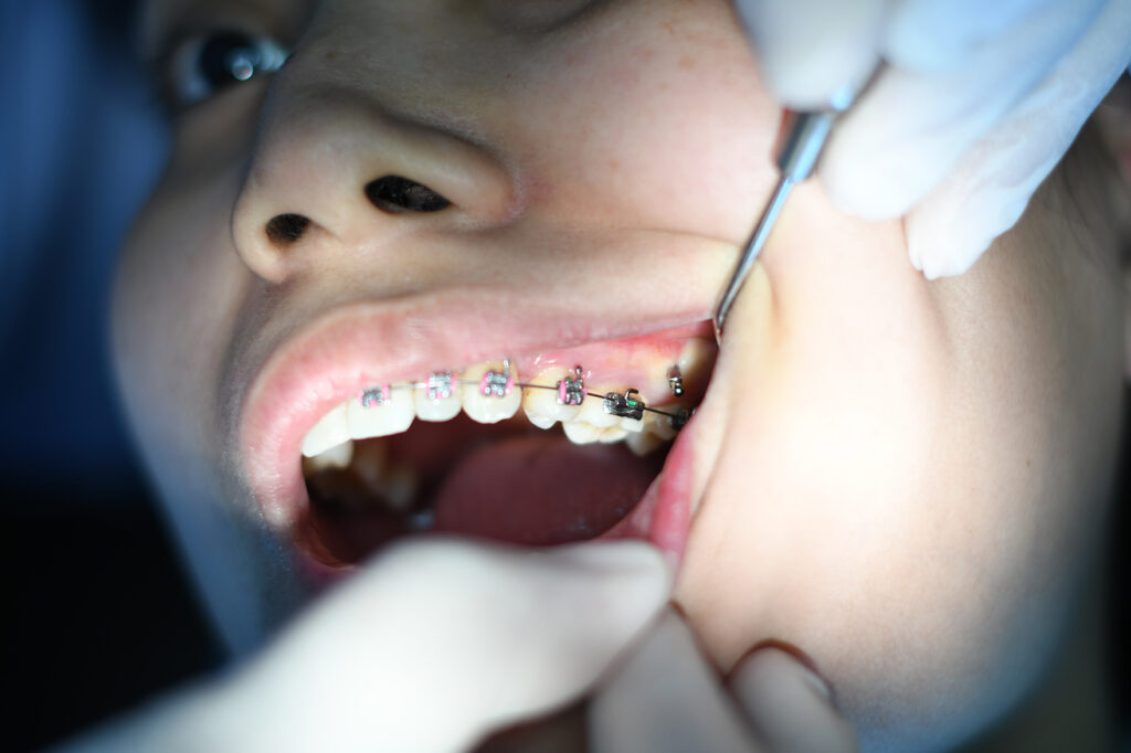 brackets que ortodoncia elegir